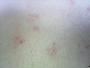 红斑的照片,照片揭示皮肤病变奥秘